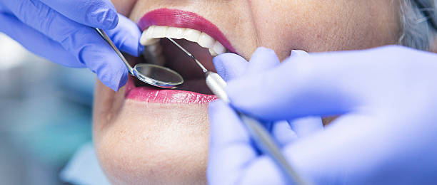 Best Knocked-Out Tooth (Avulsed Tooth) Treatment in Miami Gardens, FL